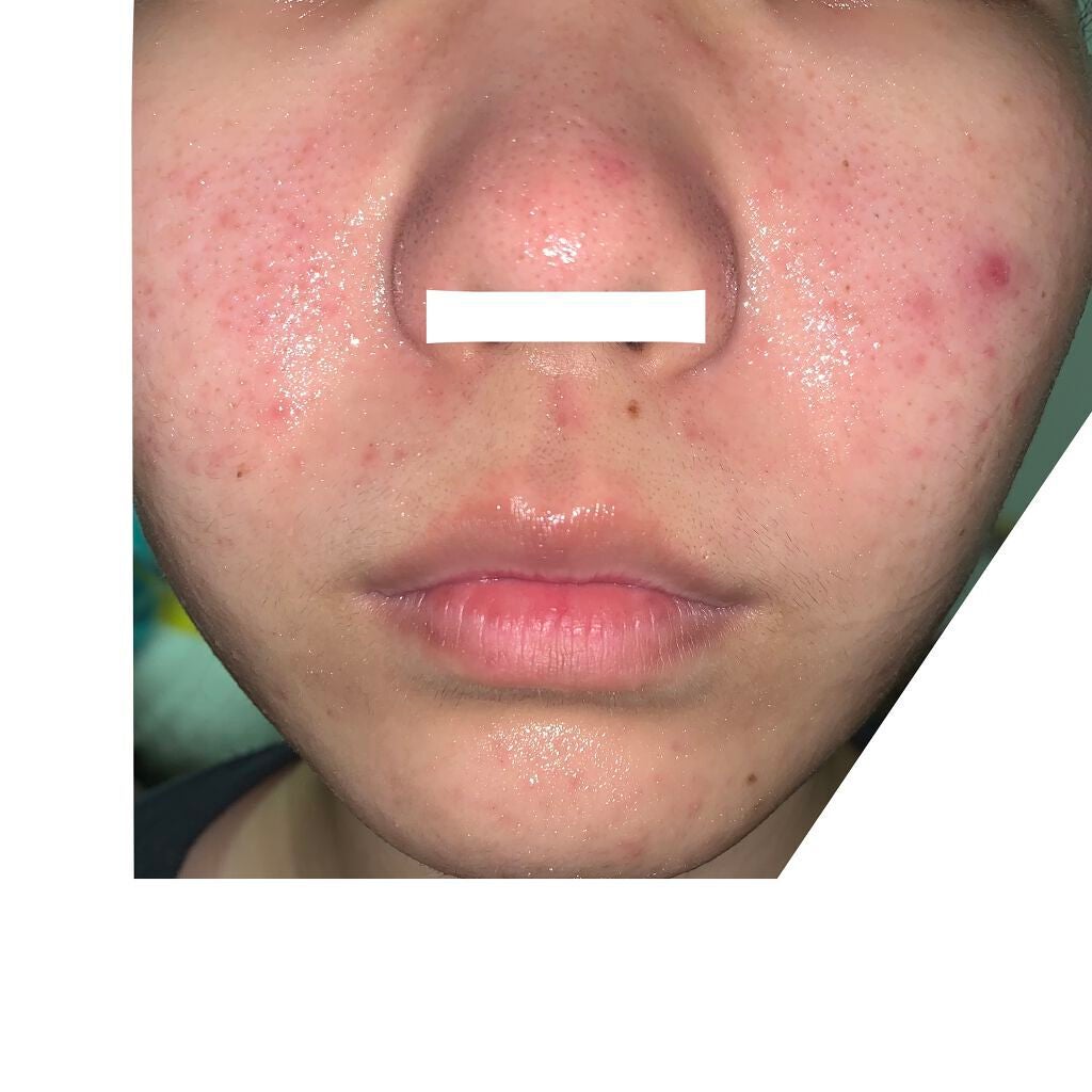 薬用しみ対策 美白化粧水/メラノCC/化粧水を使ったクチコミ(4枚目)