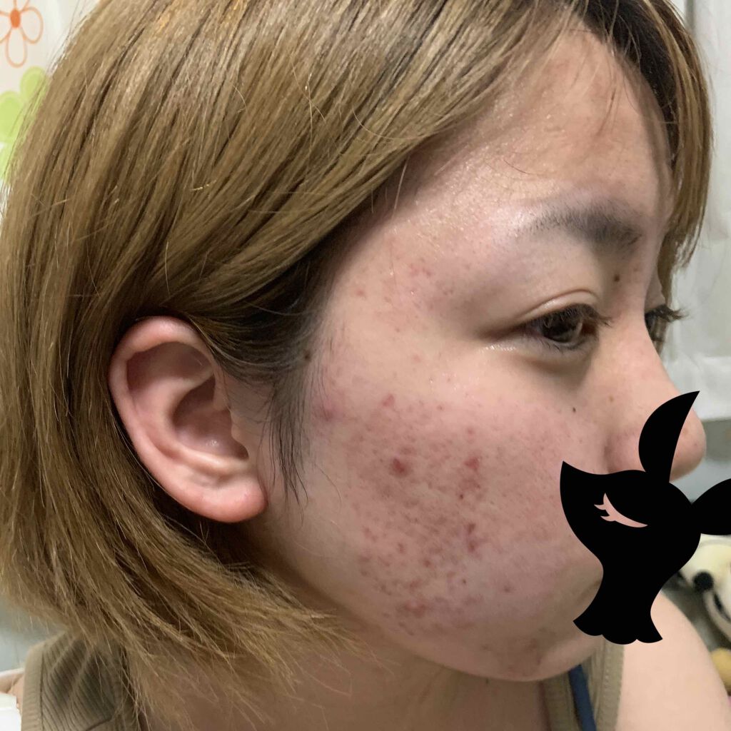 komori_ on LIPS 「全然ニキビ跡治りません。皮膚科でもらった薬も効かないし口コミで..」(1枚目)