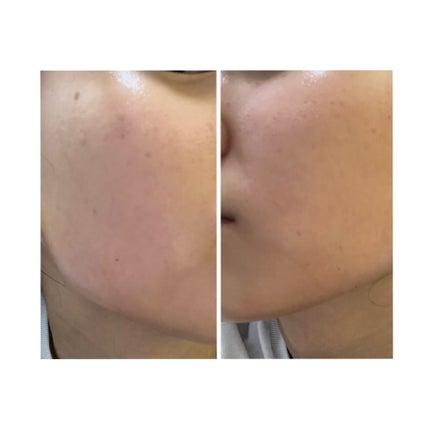 ぽむ on LIPS 「2023.9.13皮膚科に受診 エピデュオとヘパリン処方1枚目..」(5枚目)