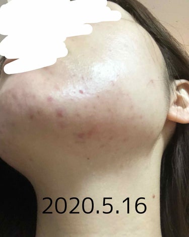 パピコ28世 on LIPS 「ニキビが治ってきて、この喜びを忘れないために、辛かったことを忘..」（4枚目）