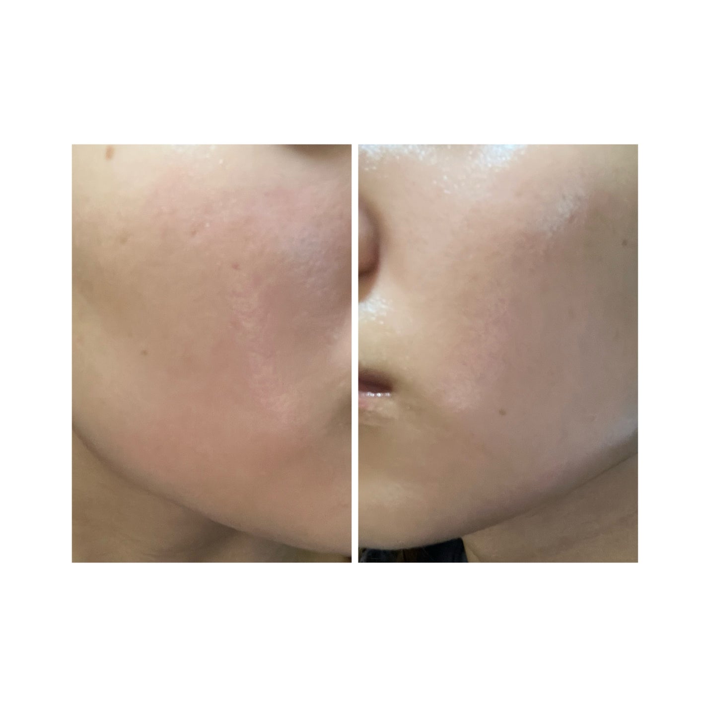 ぽむ on LIPS 「2023.9.13皮膚科に受診 エピデュオとヘパリン処方1枚目..」(5枚目)