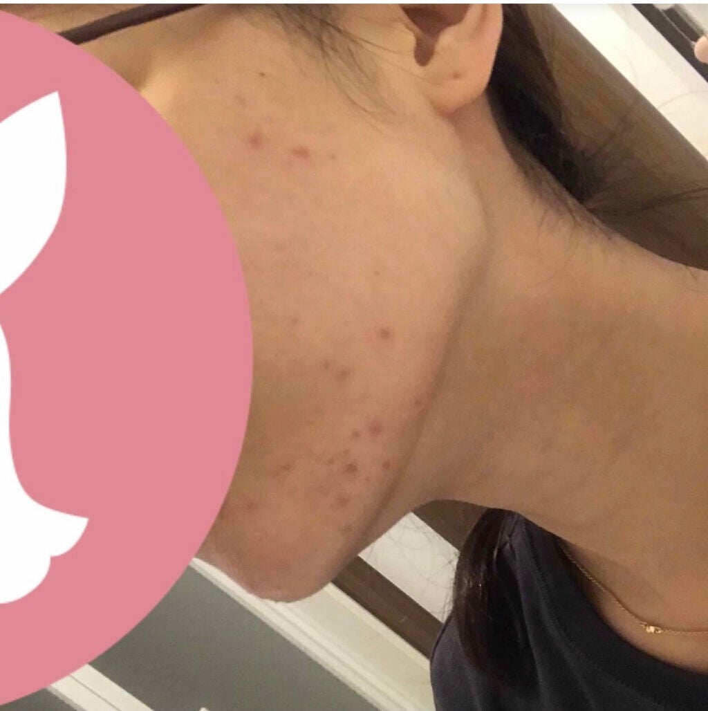 yuun on LIPS 「良くなってるのかなぁ、、?皮膚科で貰ったお薬もらってつけ始めて..」(1枚目)