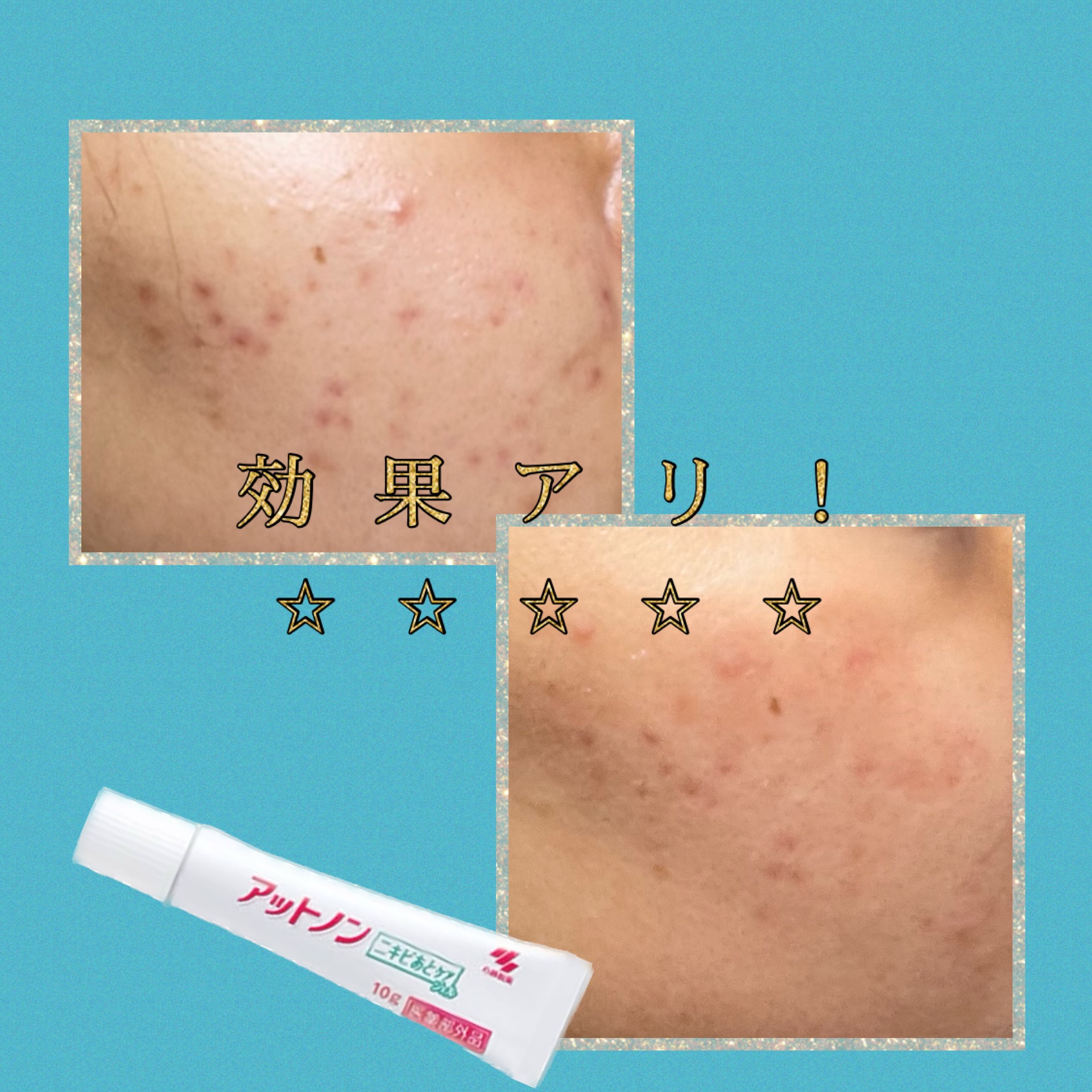 ニキビあとケアジェル/アットノン/その他スキンケアを使ったクチコミ（1枚目）