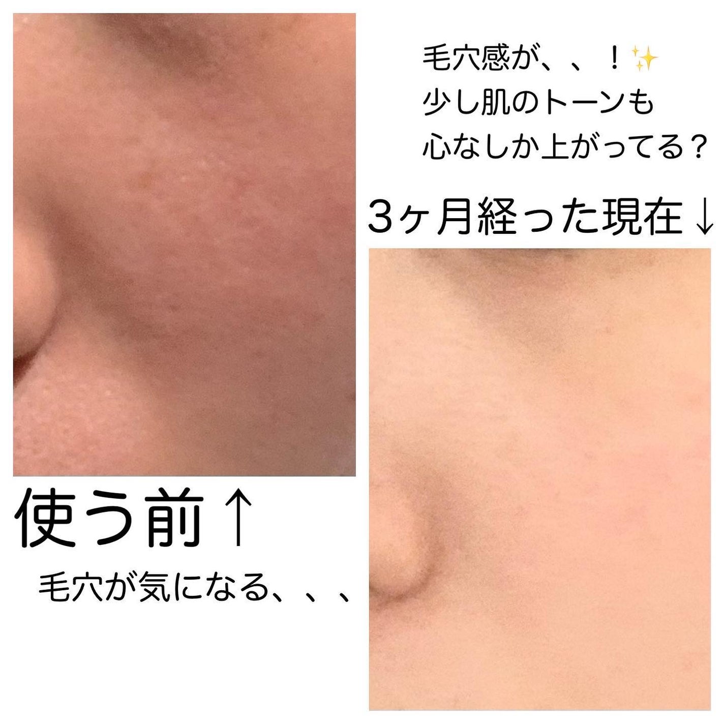 シカレチA エッセンス0.1/VT/美容液を使ったクチコミ(3枚目)