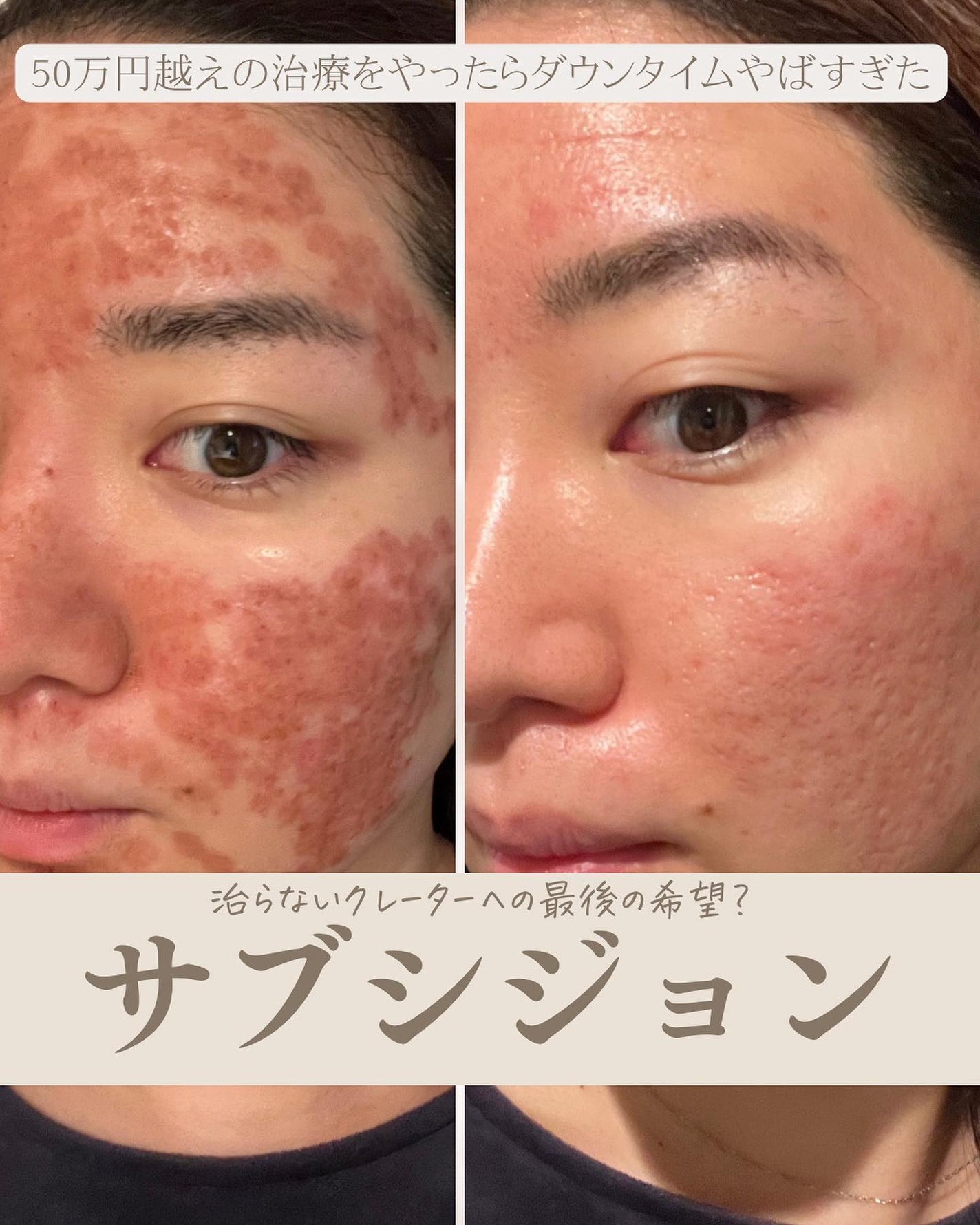 おゆみ|ニキビ・ニキビ跡ケア on LIPS 「@______ohyoume他の投稿はこちらから【サブシジョン..」(1枚目)