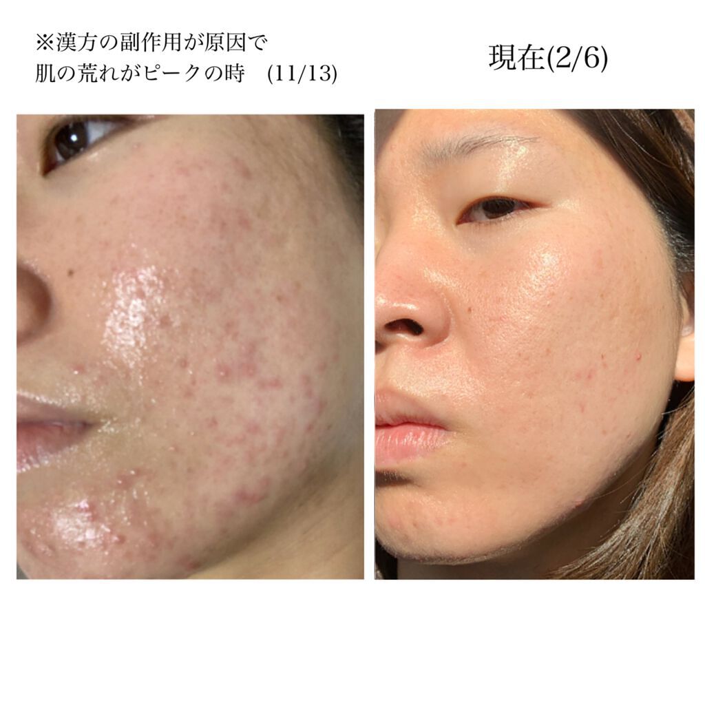 リアルカロテンブレミッシュクリアセラム/APRILSKIN/美容液を使ったクチコミ(7枚目)