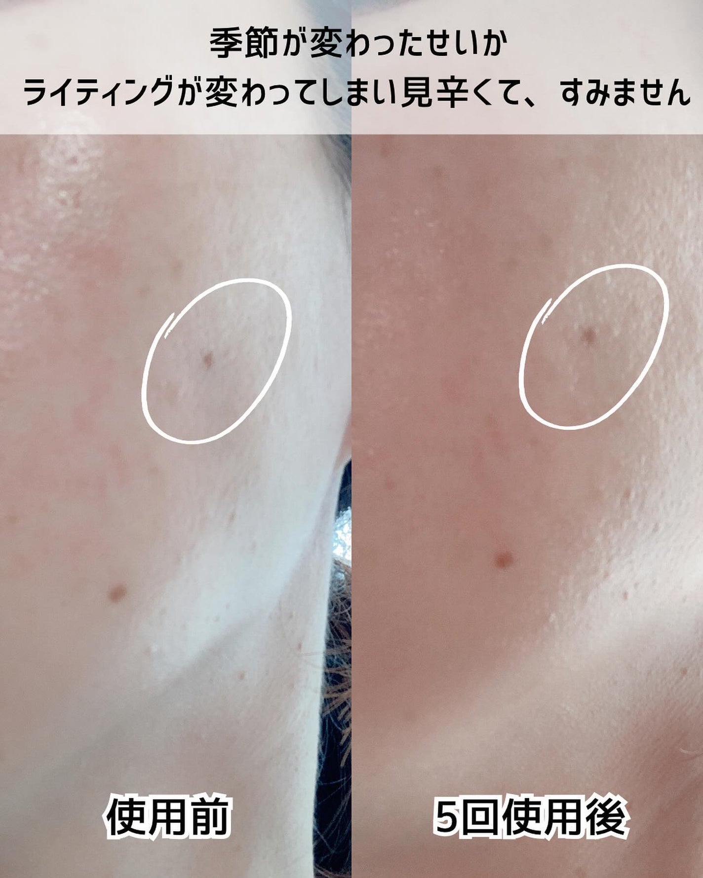 レディブラン 薬用美白シミキールパックC/シーヴァ/ピーリングを使ったクチコミ(5枚目)