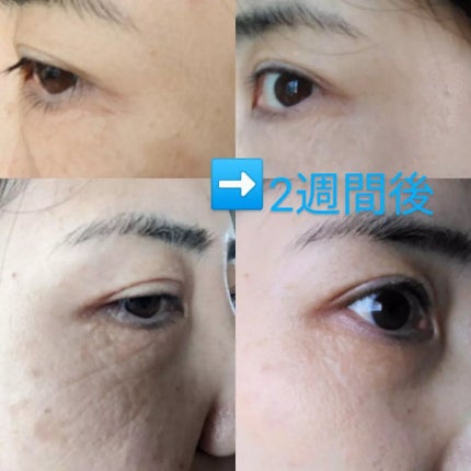 おほあんどうふ on LIPS 「もうすぐアラフィフ突入にして、憧れのプックリ涙袋形成か⁉️たる..」(2枚目)