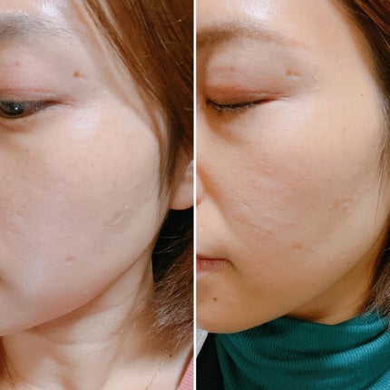 ビューティー スポットパッチ/イージーダムビューティー/にきびパッチを使ったクチコミ(8枚目)