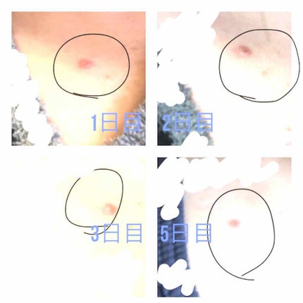 オロナインH軟膏 (医薬品)/オロナイン/その他を使ったクチコミ(2枚目)