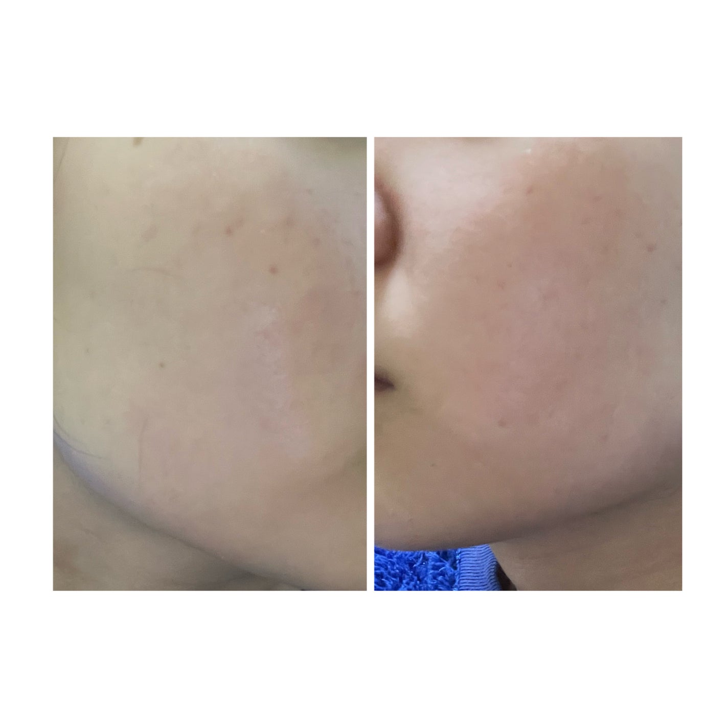 ぽむ on LIPS 「2023.9.13皮膚科に受診 エピデュオとヘパリン処方1枚目..」(3枚目)