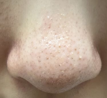 スキンケア方法 ナチュリエ ハトムギ化粧水 ナチュリエ スキンコンディショナー H ナチュリエの使い方 効果 最後は 私の毎日スキン By みーこ 脂性肌 代前半 Lips