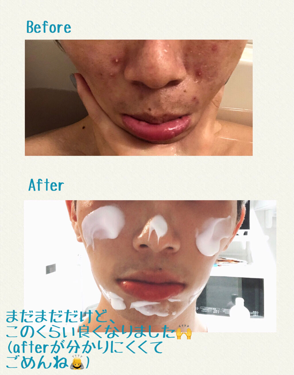 オードムーゲ 薬用ローション（ふきとり化粧水）/オードムーゲ/拭き取り化粧水を使ったクチコミ（1枚目）