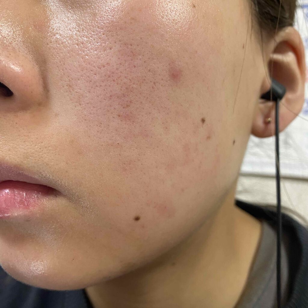 ゼビアックス(医薬品)/マルホ株式会社/その他を使ったクチコミ（1枚目）