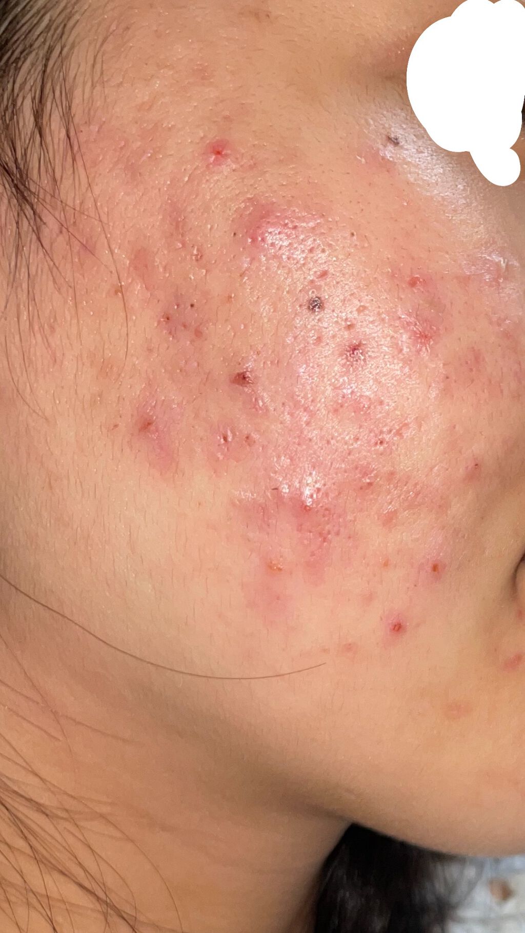 a on LIPS 「⚠️注意⚠️⚠️注意⚠️助けてください!!肌が今最大級に荒れて..」(3枚目)