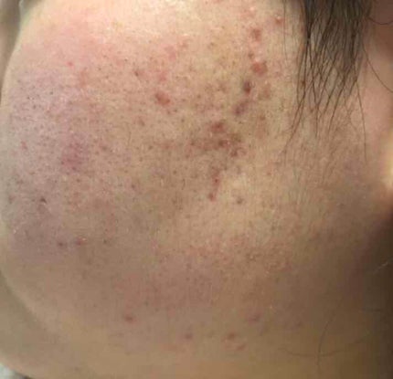 薬用保湿化粧水/オードムーゲ/化粧水を使ったクチコミ(4枚目)