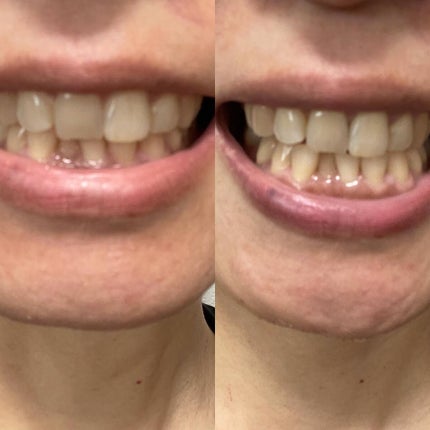 PTPハミガキ /プレビュート/歯磨き粉を使ったクチコミ(5枚目)