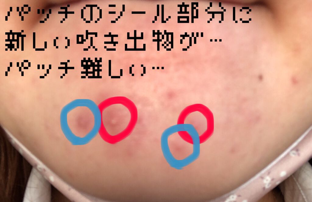 ACケア/ACROPASS/その他スキンケアを使ったクチコミ（2枚目）