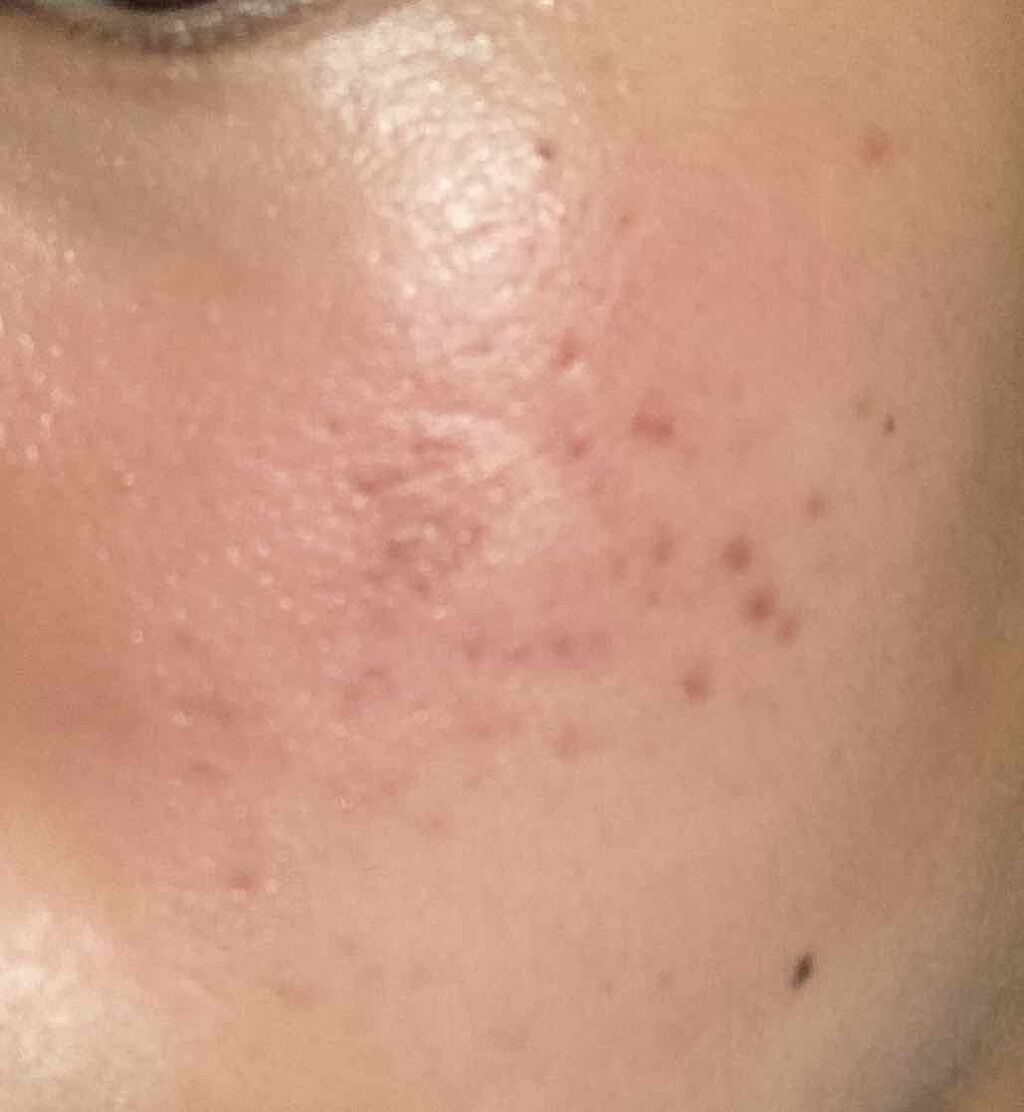 薬用 しみ 集中対策 美容液/メラノCC/美容液を使ったクチコミ（3枚目）