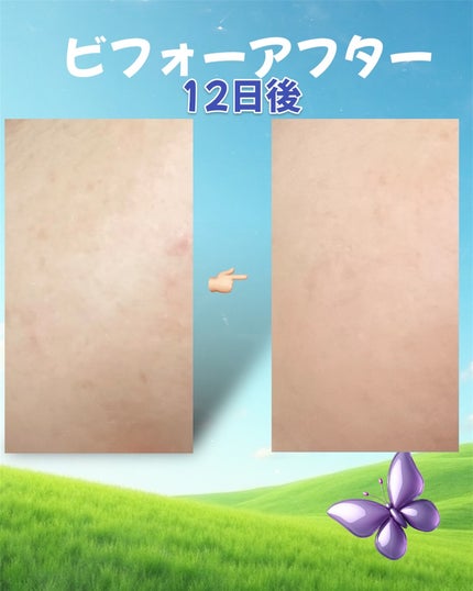 ビタコラーゲン ブライトニング アンプル/ダーマフィックス/美容液を使ったクチコミ(7枚目)