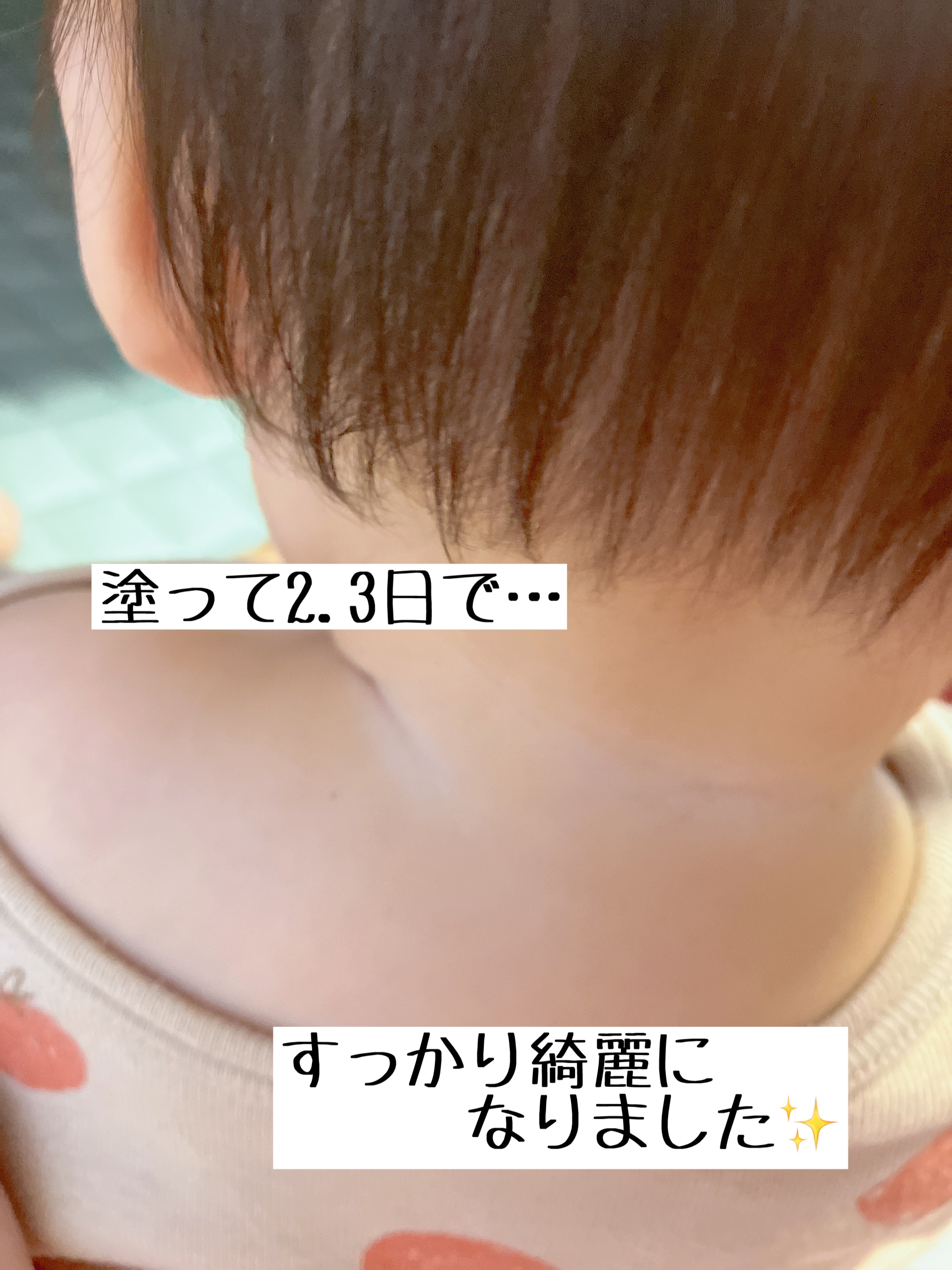 あせもクリーム(医薬品)/ユースキン/その他を使ったクチコミ（3枚目）