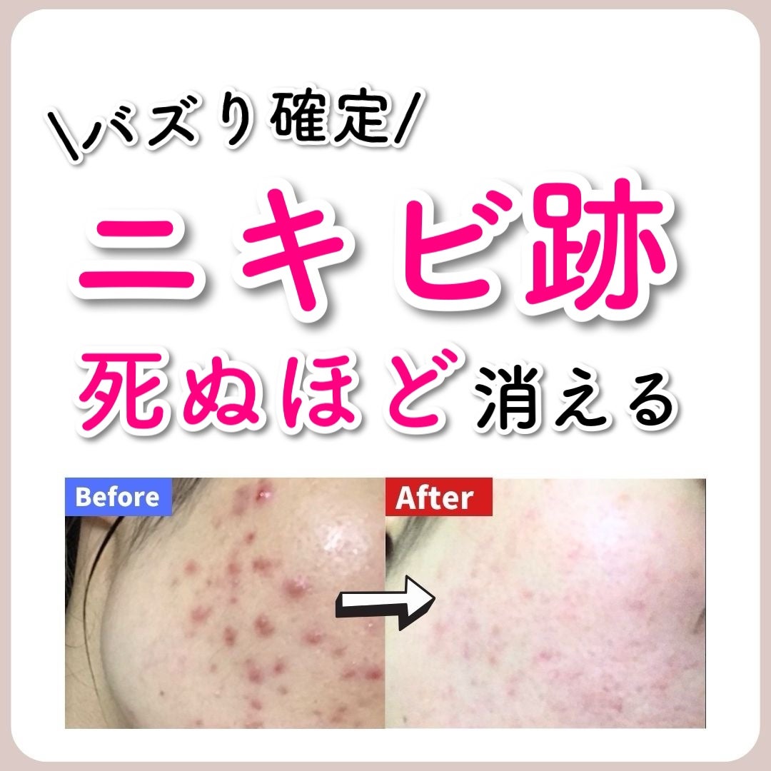 あなたの肌に合ったスキンケア💐コーくん先生 on LIPS 「【バズり確定】ニキビ跡エグいほど消える方法...あなたの毛穴の..」(1枚目)