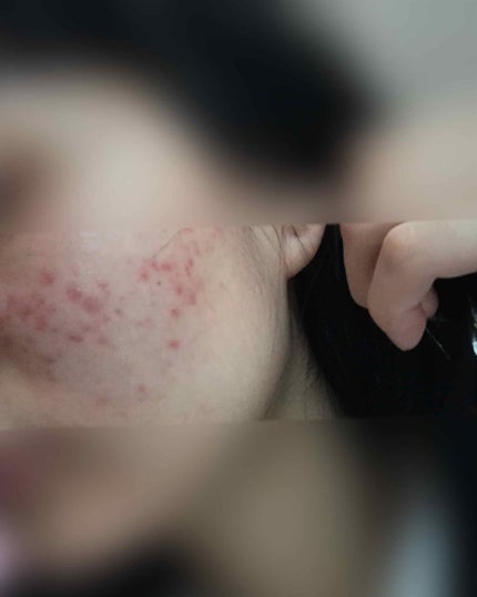 オードムーゲ 薬用ローション(ふきとり化粧水)/オードムーゲ/拭き取り化粧水を使ったクチコミ(2枚目)