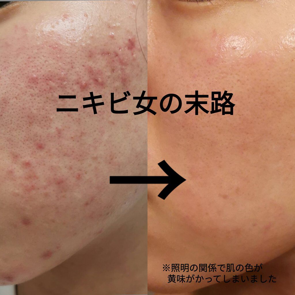 美白になる方法 保湿浸透水モイストリッチ 肌をうるおす保湿スキンケアの美白効果 使い方 私がニキビを治した方 By 汚肌ちゃん アトピー肌 代前半 Lips 美白になる方法 保湿浸透水モイストリッチ 肌をうるおす保湿スキンケアの美白効果 使い方 私がニキビを治した方 By 汚肌ちゃん アトピー肌 代前半 Lips