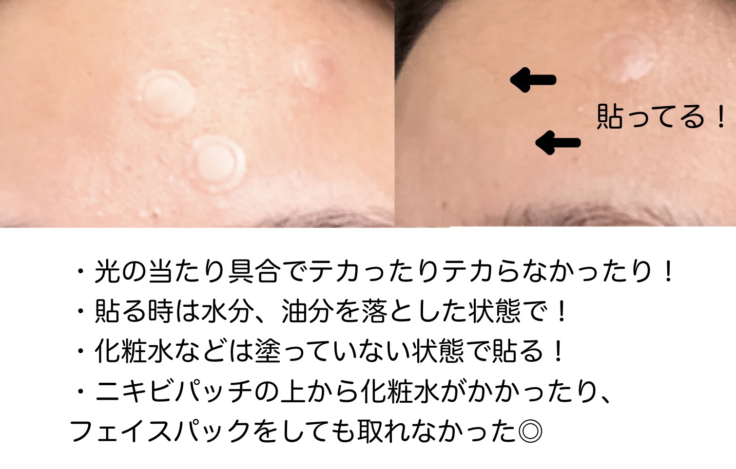 ゼロスポットパッチ/Today’s Cosme/にきびパッチを使ったクチコミ（3枚目）