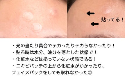ゼロスポットパッチ/Today’s Cosme/にきびパッチを使ったクチコミ(3枚目)