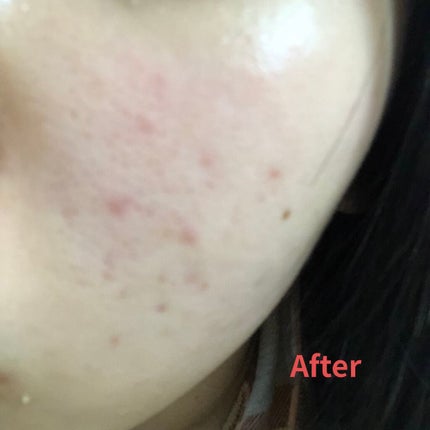 ニキビ治療薬(医薬品)/メンソレータム アクネス/その他を使ったクチコミ(4枚目)