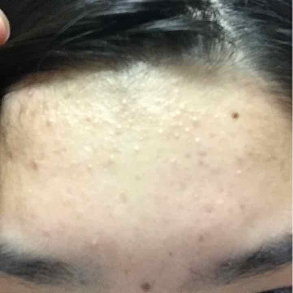 a_no on LIPS 「皮膚科に行ってこんな感じです。飲み薬と塗り薬を使っています。赤..」(1枚目)