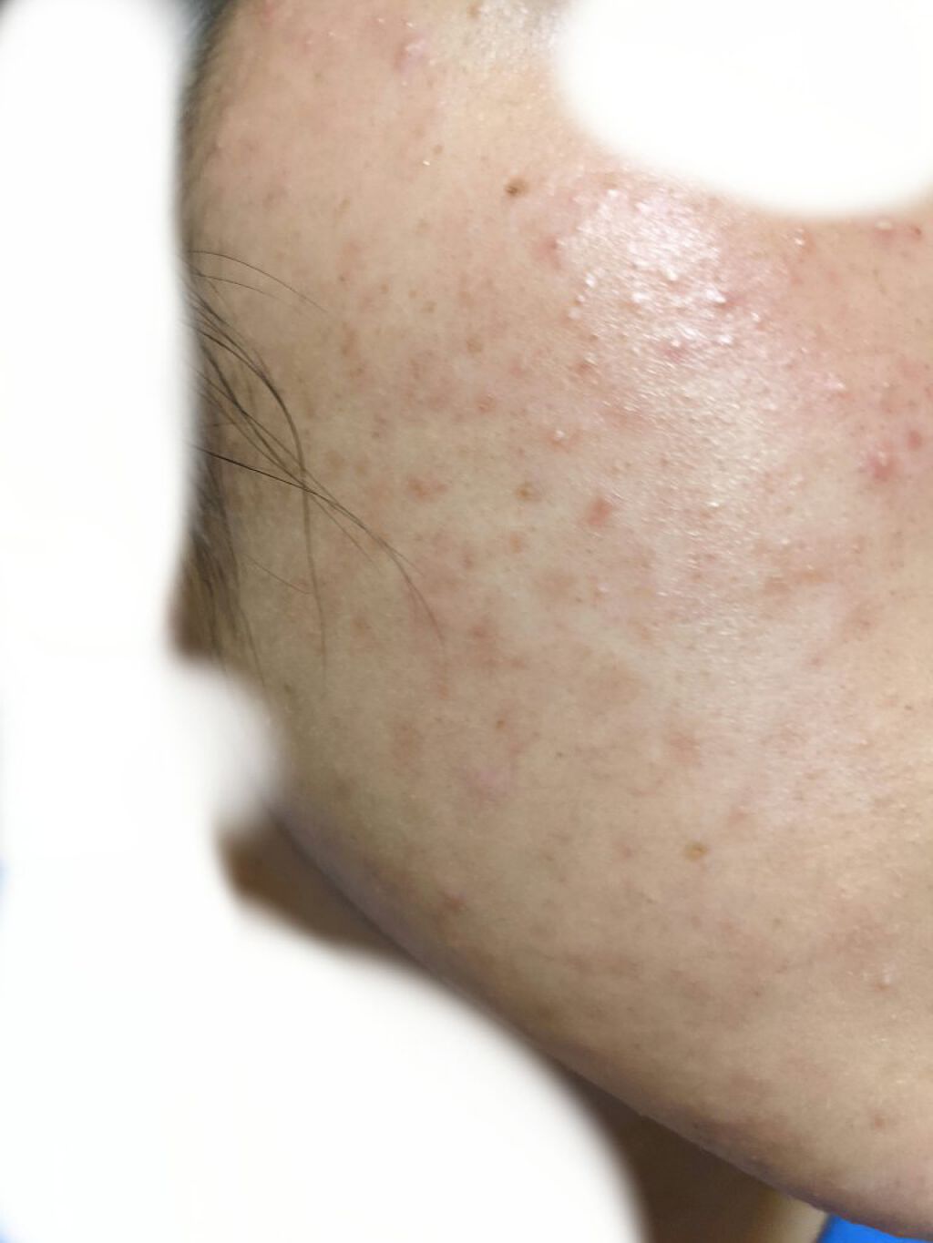 ベピオゲル/マルホ株式会社/その他を使ったクチコミ（2枚目）