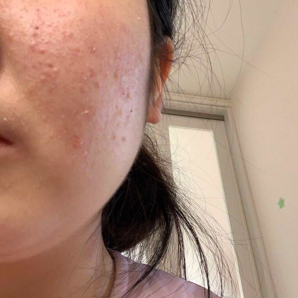 ちひろ on LIPS 「ーニキビ日記6ヶ月7日目ーこんにちは😃最近本当に肌は乾燥気味で..」(2枚目)