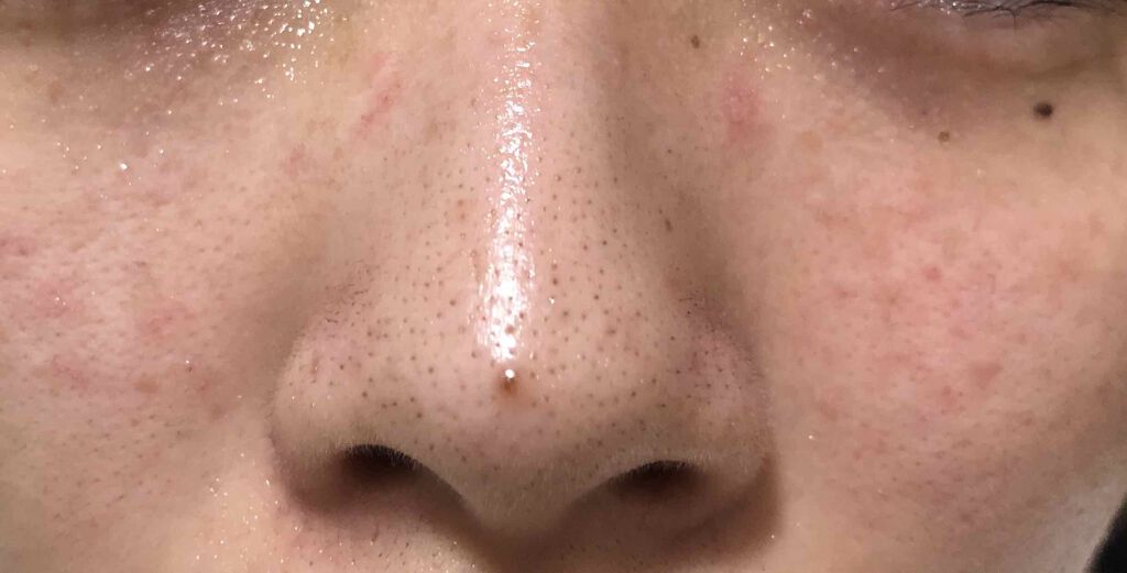 まな@YouTube on LIPS 「お肌改善計画第三弾です!💓🌈レーザー跡に塗る薬塗ってるのでテカ..」(4枚目)