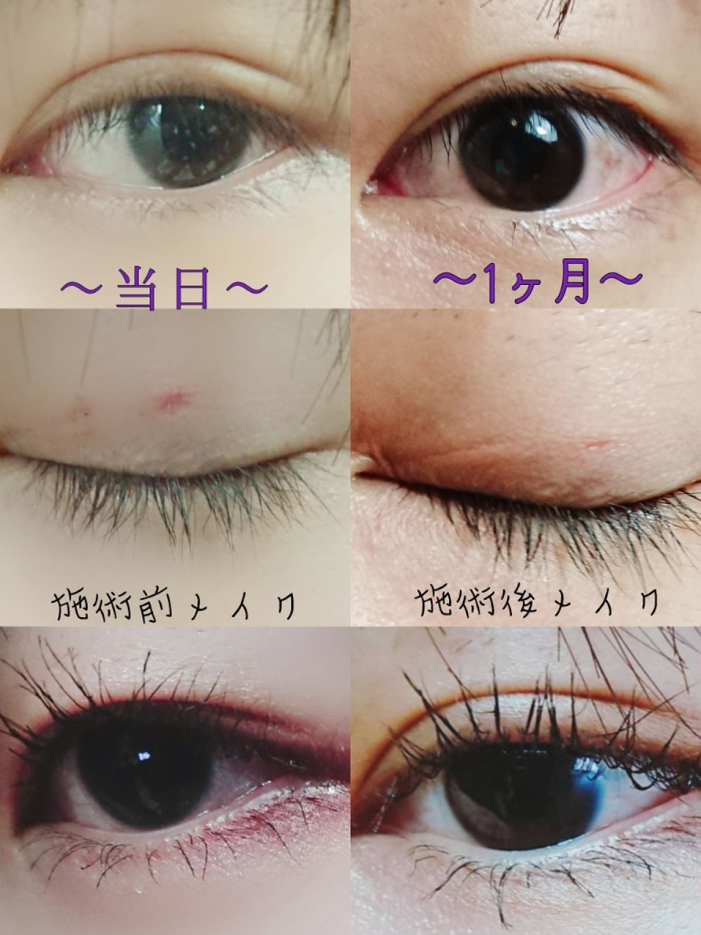 ばさお on LIPS 「術後経過シリーズ最終回(?)になります🙏かれこれ1ヶ月経ちまし..」(2枚目)