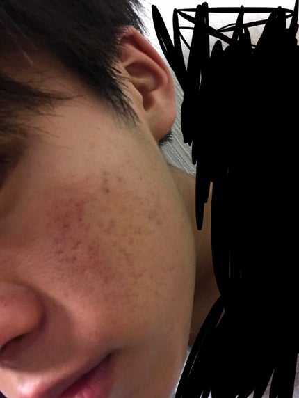 ビーソフテン ローション(医薬品)/持田製薬/その他を使ったクチコミ(1枚目)