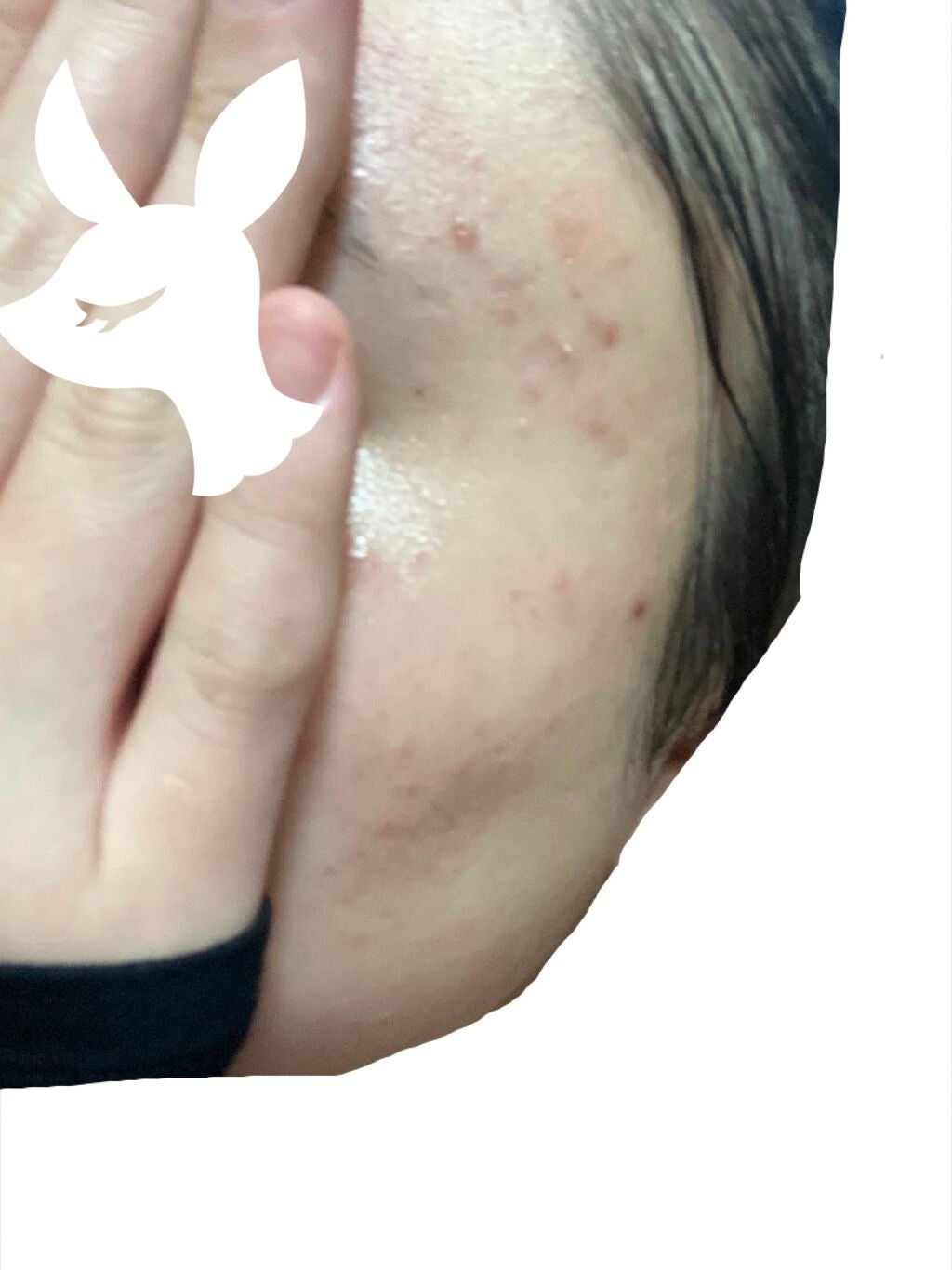 ぺーさん on LIPS 「ひどいニキビですみません。ストレスやホルモンバランスが崩れると..」(1枚目)