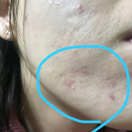 レチノールA 1% アドバンスドリバイタリゼーションクリーム/Life-flo/フェイスクリームを使ったクチコミ(2枚目)