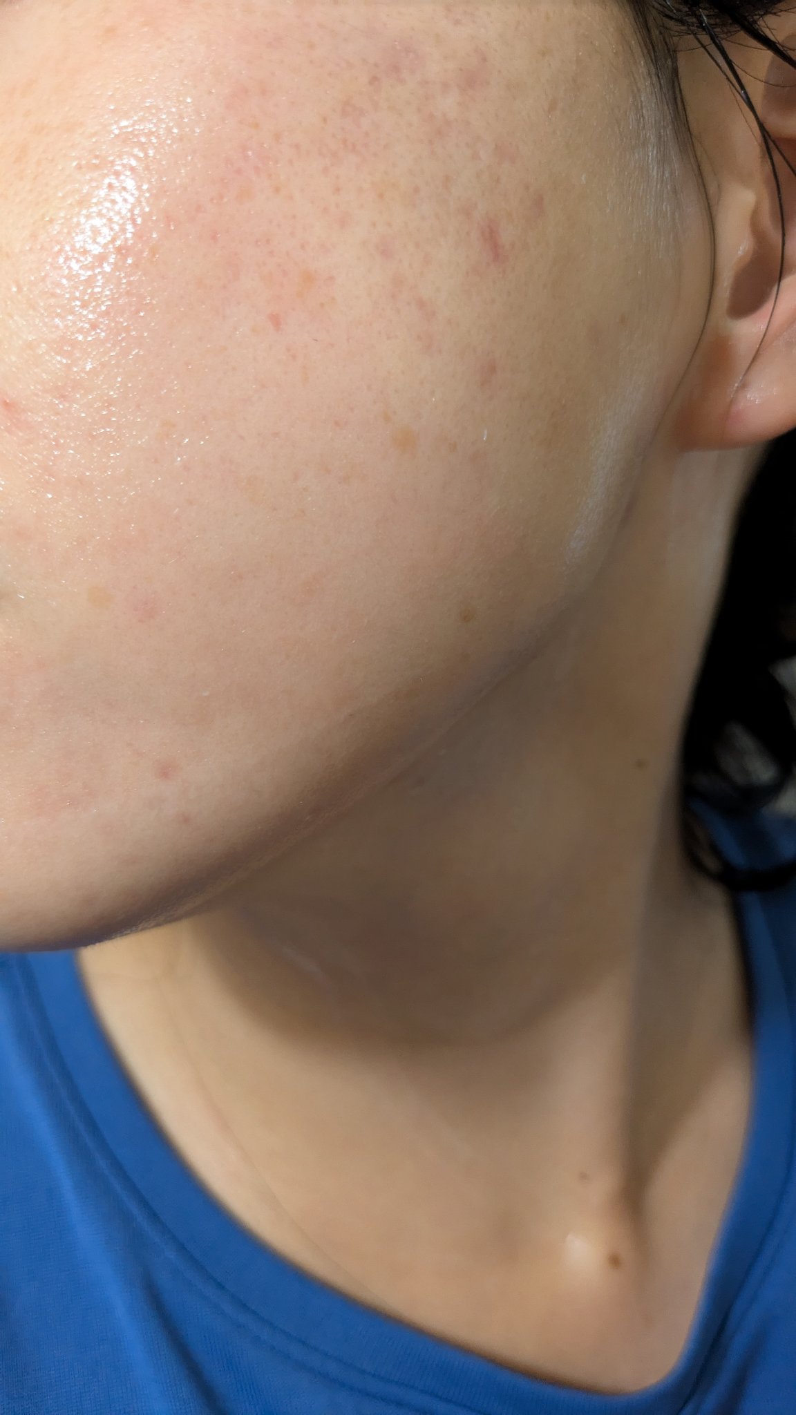 A2+NAG2ソリューション/The Ordinary/美容液を使ったクチコミ（2枚目）