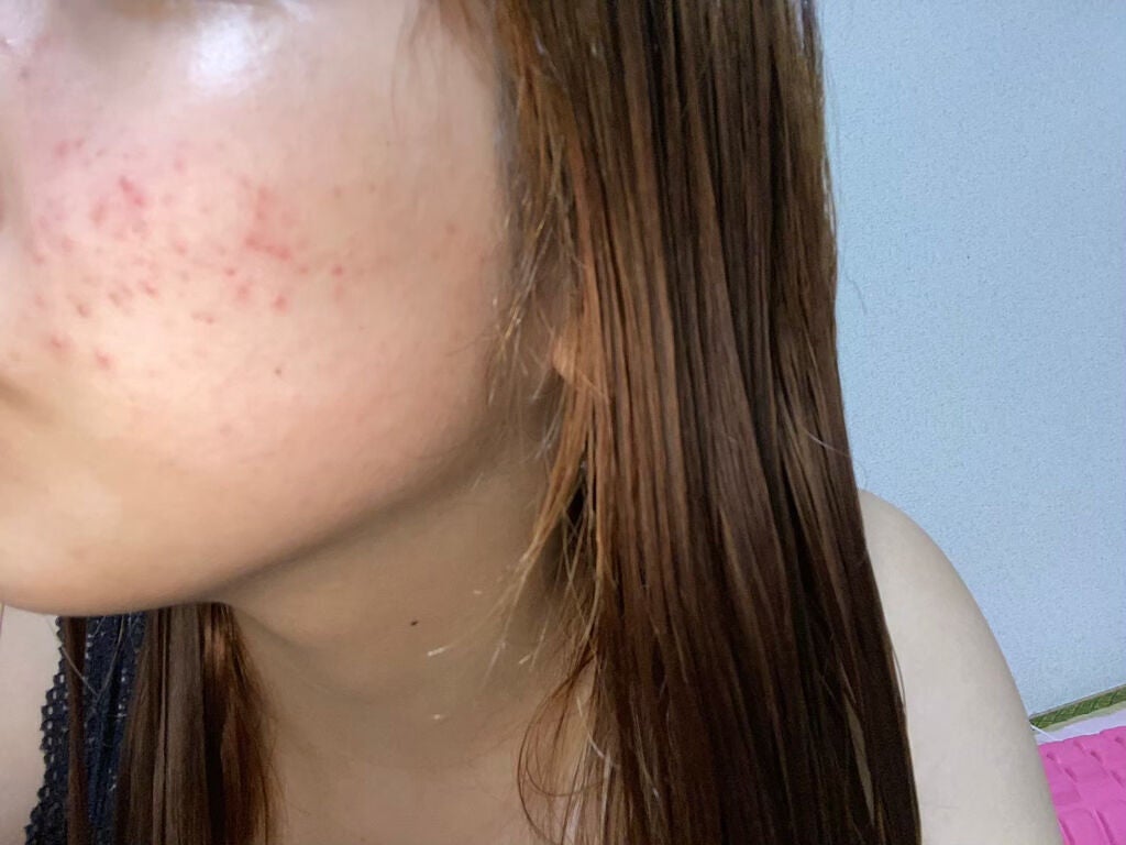 薬用しみ集中対策 プレミアム美容液/メラノCC/美容液を使ったクチコミ(1枚目)