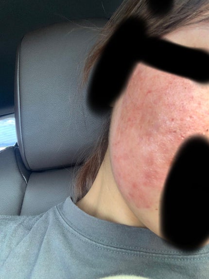 デュアック配合ゲル/ポーラファルマ/その他を使ったクチコミ(2枚目)