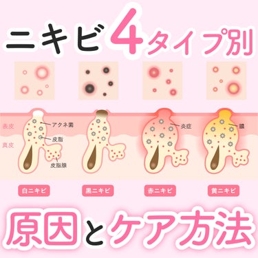 薬用ふわふわな泡洗顔/メンソレータム アクネス/泡洗顔を使ったクチコミ（1枚目）