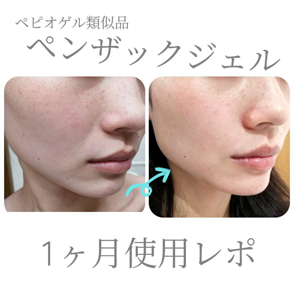 Haruka on LIPS 「ペピオゲルの類似品、ベンザックジェルを約1ヶ月使用した感想です..」(1枚目)