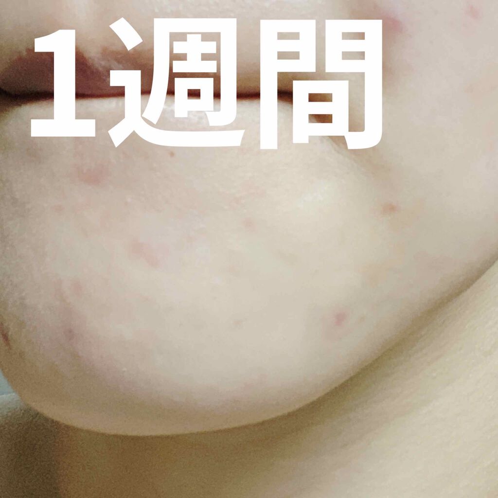 ゼロスポットパッチ/Today’s Cosme/にきびパッチを使ったクチコミ(4枚目)