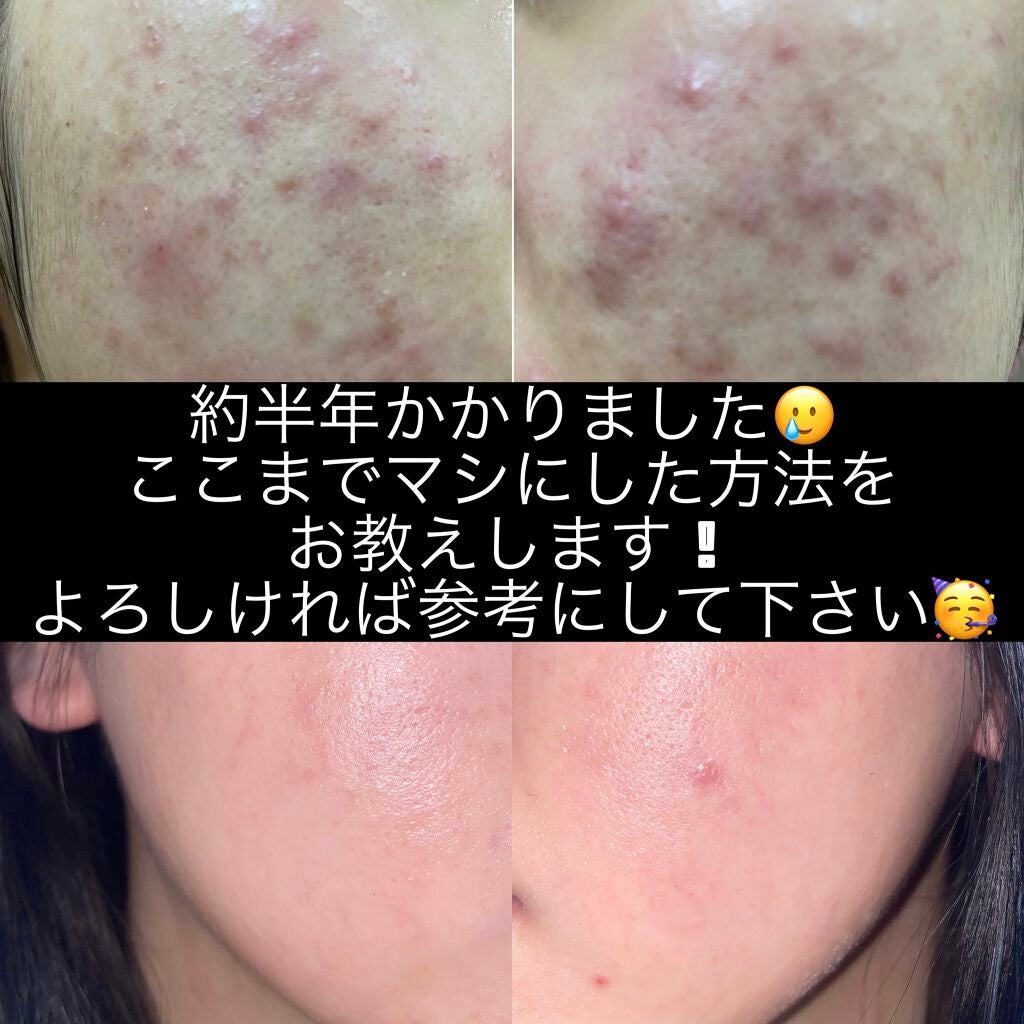 パーフェクトホイップn/SENKA(専科)/洗顔フォームを使ったクチコミ(1枚目)