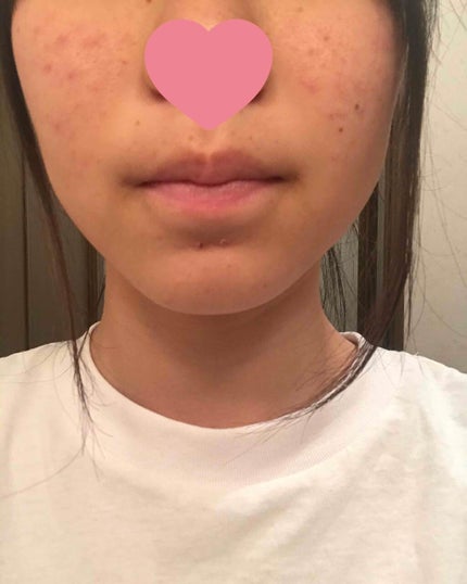 どれいちゃん on LIPS 「写真で見てもらう通りすごい肌が荒れてしまっています…・今してる..」(1枚目)