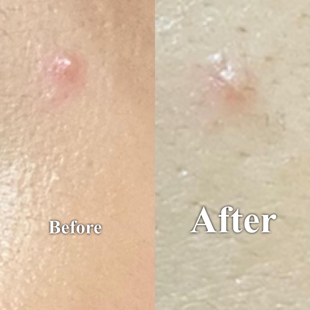 アクネスラボ 相澤メソッド 薬用ミドリクリーム/HIN アクネスラボ/フェイスクリームを使ったクチコミ(6枚目)