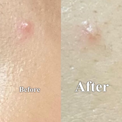 アクネスラボ 相澤メソッド 薬用ミドリクリーム/HIN アクネスラボ/フェイスクリームを使ったクチコミ(6枚目)