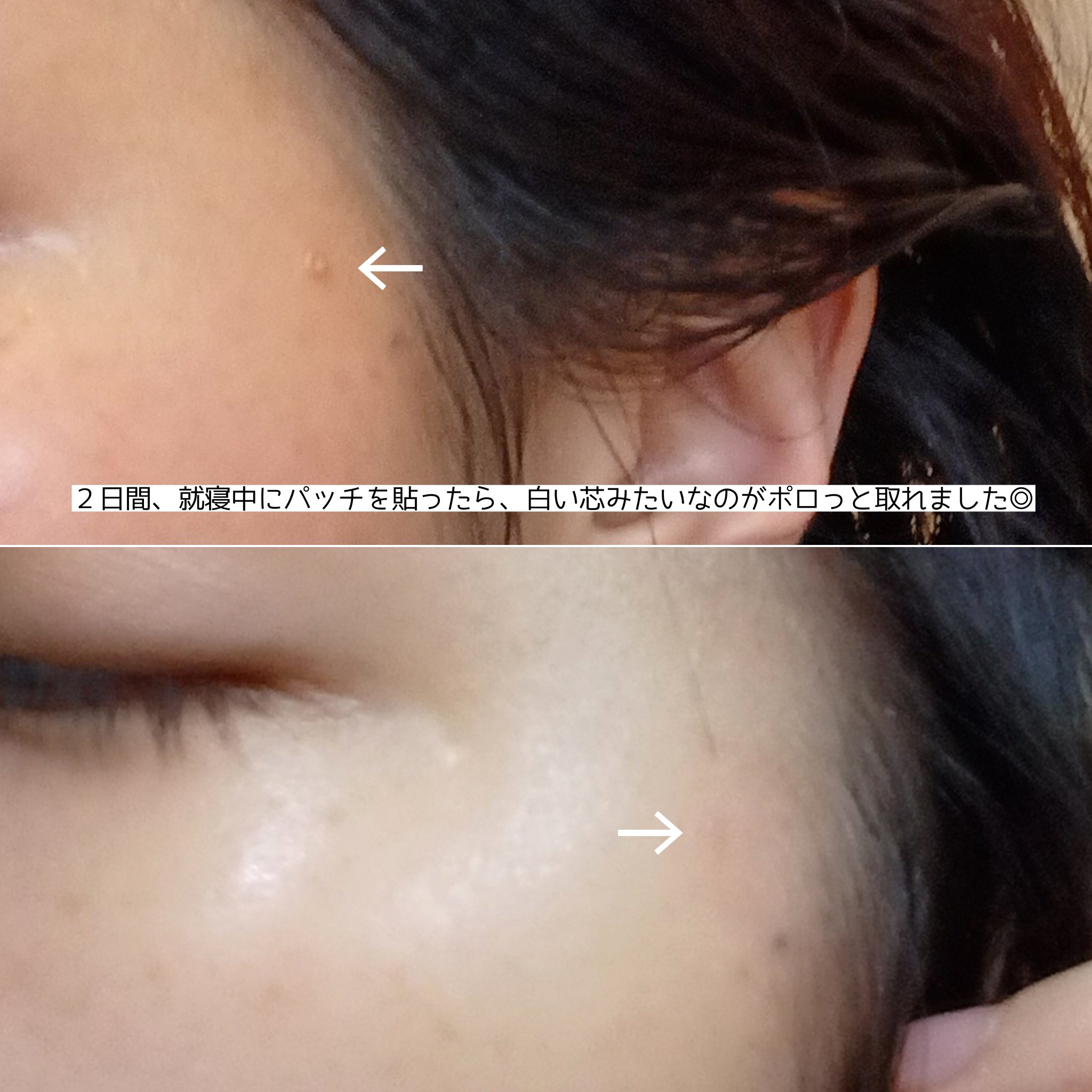 プロCICA クリアスポットパッチ/VT/その他スキンケアを使ったクチコミ（3枚目）